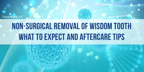 Non-Surgical Removal Of Wisdom Tooth: What To Expect And Aftercare Tips