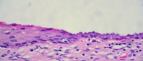 What Is An Incompetent Cervix During Pregnancy?