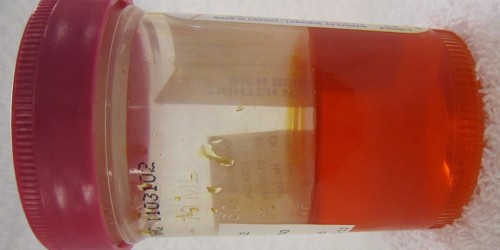 Orange Urine: Benign Medication Side Effect, Or Sign Of Serious Disease?