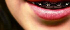 Orthodontic Braces: Common (And Less Common) Questions Answered