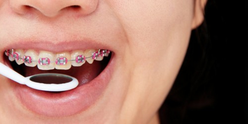 Orthodontic Treatment: What Is The Best Time To Straighten Teeth And Correct An Improper Bite?