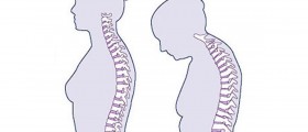 Osteoporosis Can Strike at Thirty