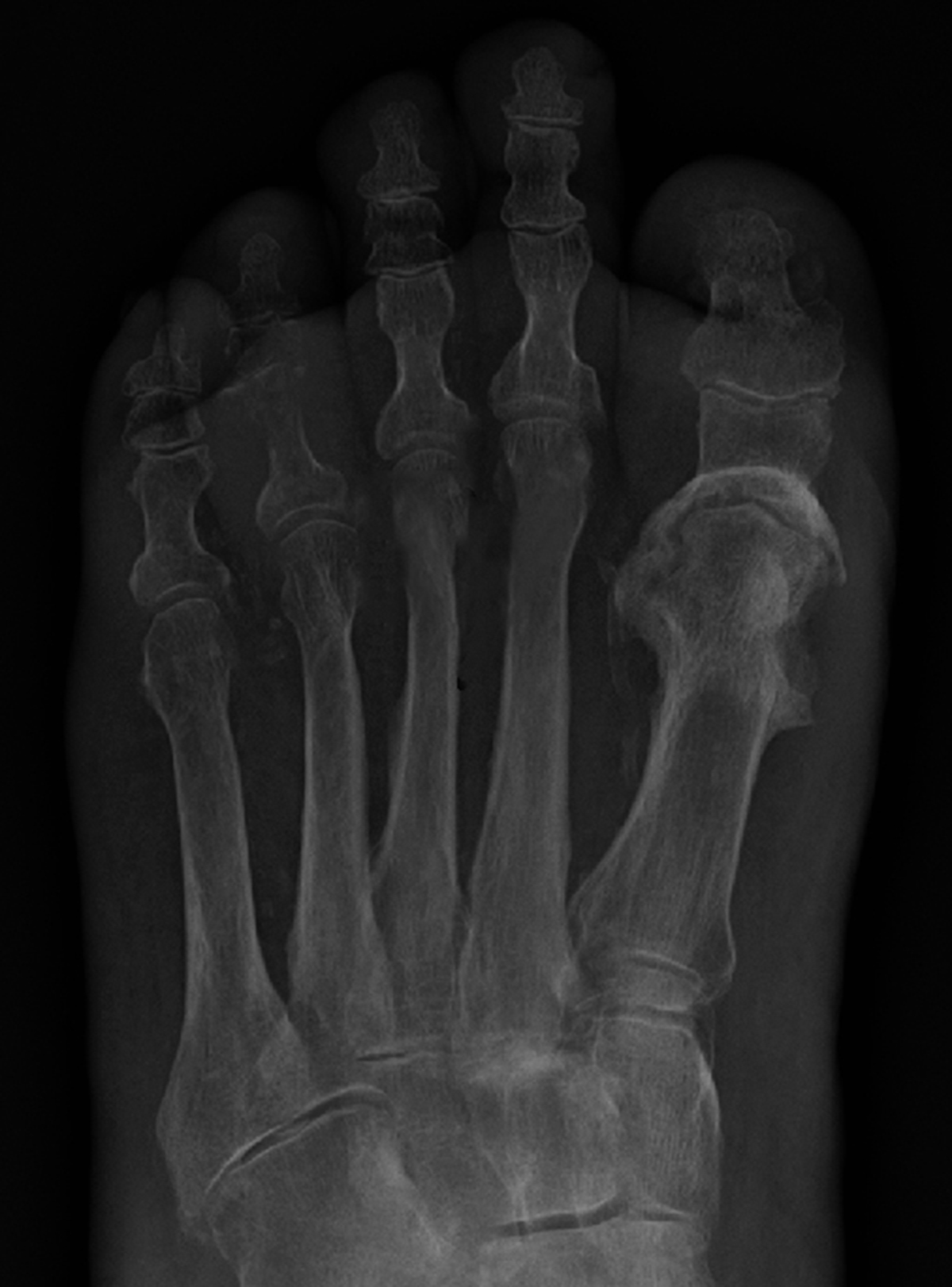 osteomyelitis bone infection arthritis septic toe disease symptoms vs specific