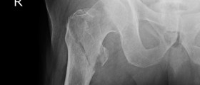 Osteoporosis And Broken Bones: What Can You Expect From Hip Fractures?