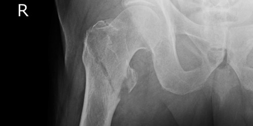 Osteoporosis And Broken Bones: What Can You Expect From Hip Fractures?
