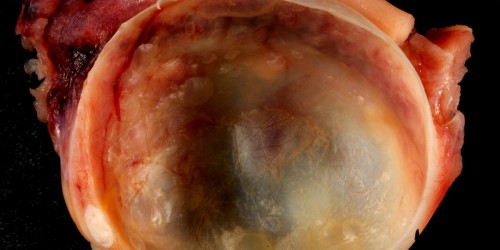 Ovarian Cysts And Pregnancy