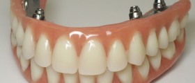 Are Overdentures Right For You?