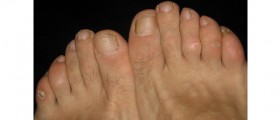 Don't Suffer With Painful Ugly Corns On Your Feet
