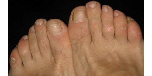 Don't Suffer With Painful Ugly Corns On Your Feet