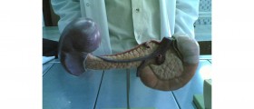 Different Experiences with Pancreatitis Diet and Life Style Changes
