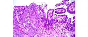 Pap Smear: Test for Abnormalities