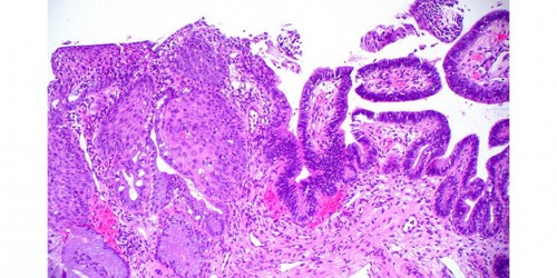 Pap Smear: Test for Abnormalities