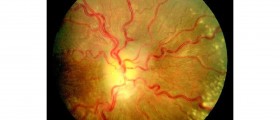 Intracranial Hypertension: Pseudotumor Cerebri