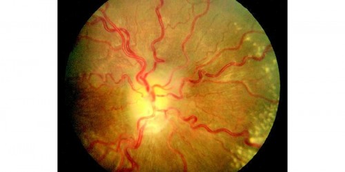 Intracranial Hypertension: Pseudotumor Cerebri