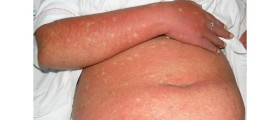 Growing Dengue Fever Incidence Calls For Proper Disease Control
