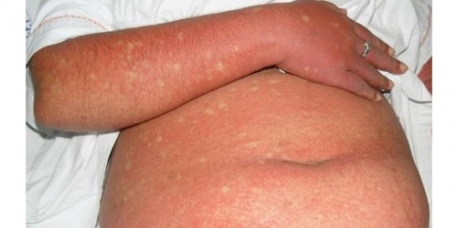 Growing Dengue Fever Incidence Calls For Proper Disease Control