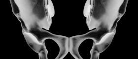 Snapping Hip Syndrome