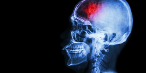 Periodontitis And Your Brain: Can Advanced Periodontal (Gum) Disease Cause A Stroke?