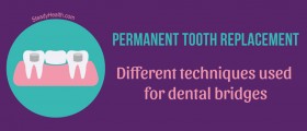 Permanent Tooth Replacement: Different Techniques Used For Dental Bridges