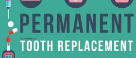 Permanent Tooth Replacement In Diabetic Patients
