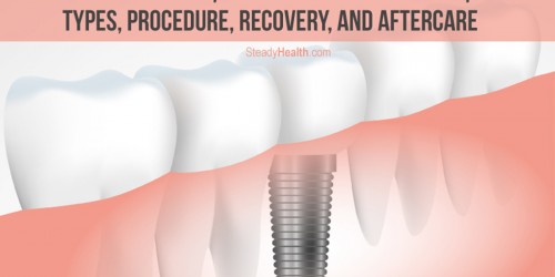 Permanent Tooth Replacement With Dental Implants: Types, Procedure, Recovery, And Aftercare