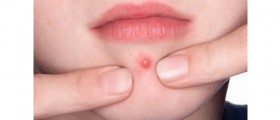 How To Stop Picking At Acne