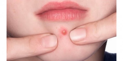 How To Stop Picking At Acne