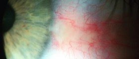 Pinguecula