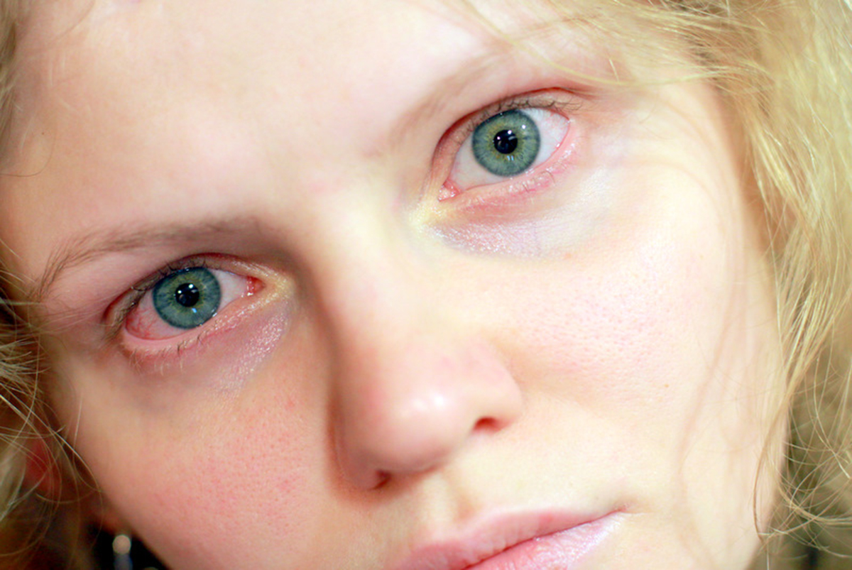 pink-eye-essential-things-you-should-know-about-conjunctivitis-eye