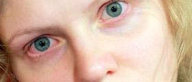 Pink Eye: Essential Things You Should Know About Conjunctivitis