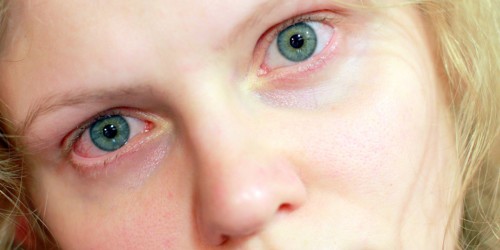 Pink Eye: Essential Things You Should Know About Conjunctivitis