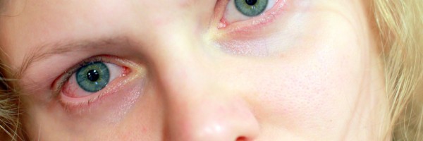 Pink Eye: Essential Things You Should Know About Conjunctivitis