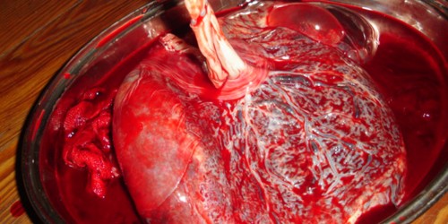 Pregnancy: What Restrictions Can You Expect With Placenta Previa?