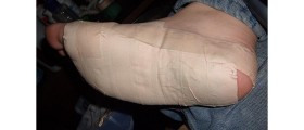 Don't Suffer With Heel Pain - It Can Easily Be Treated