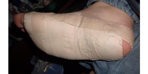 Don't Suffer With Heel Pain - It Can  Easily Be Treated