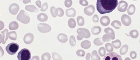 Myeloproliferative Disorders: Polycythemia vera