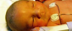 Alagille Syndrome: Causes, Symptoms, Treatment