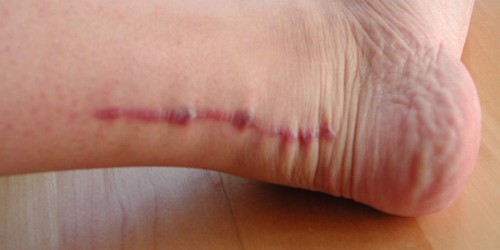 Achilles Tendon Rupture: Exercises For Recovery After Surgery