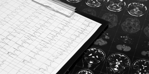 Postural Orthostatic Tachycardia Syndrome (POTS)