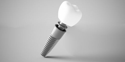Preparing For Dental Implants: What Side Effects Are most Common?