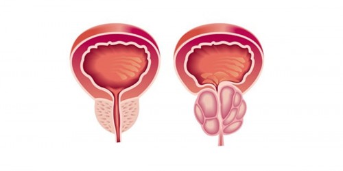 Why Men Sometimes Choose Not To Get Prostate Cancer Treatment