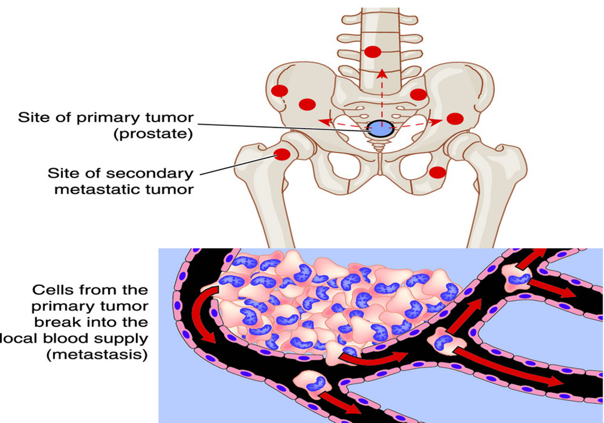 ucla-researchers-discover-potential-of-dna-markers-to-predict-prostate