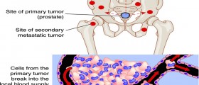 Prostate Cancer: Should A PSA Screening Be A Routine Part Of Medical Care?