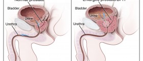Prostatitis cure & treatment