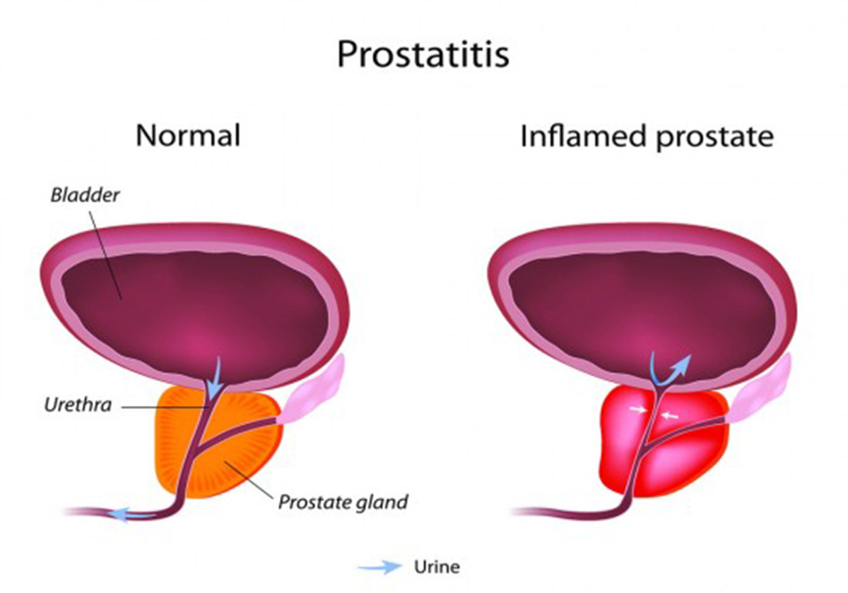 okarok okar kezelés a prosztatitis omnik krónikus prosztatitis