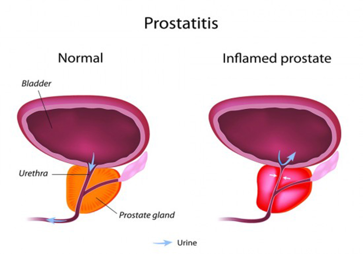 prostatit elieve