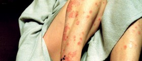 There's A New Drug In Town For Plaque Psoriasis - Enstilar