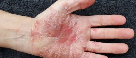Manage and Track Psoriasis With Mobile Medical Apps
