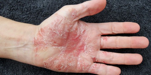 Manage and Track Psoriasis With Mobile Medical Apps