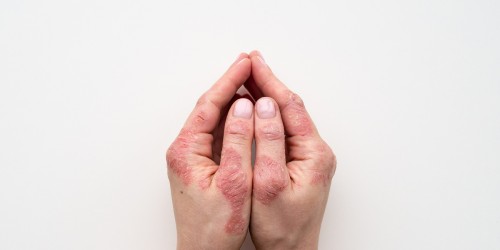 Psoriasis Awareness Month: Psoriasis Treatment For The 21st Century
